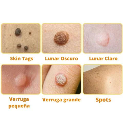 Tag Recede™ Spray Eliminador de Verrugas